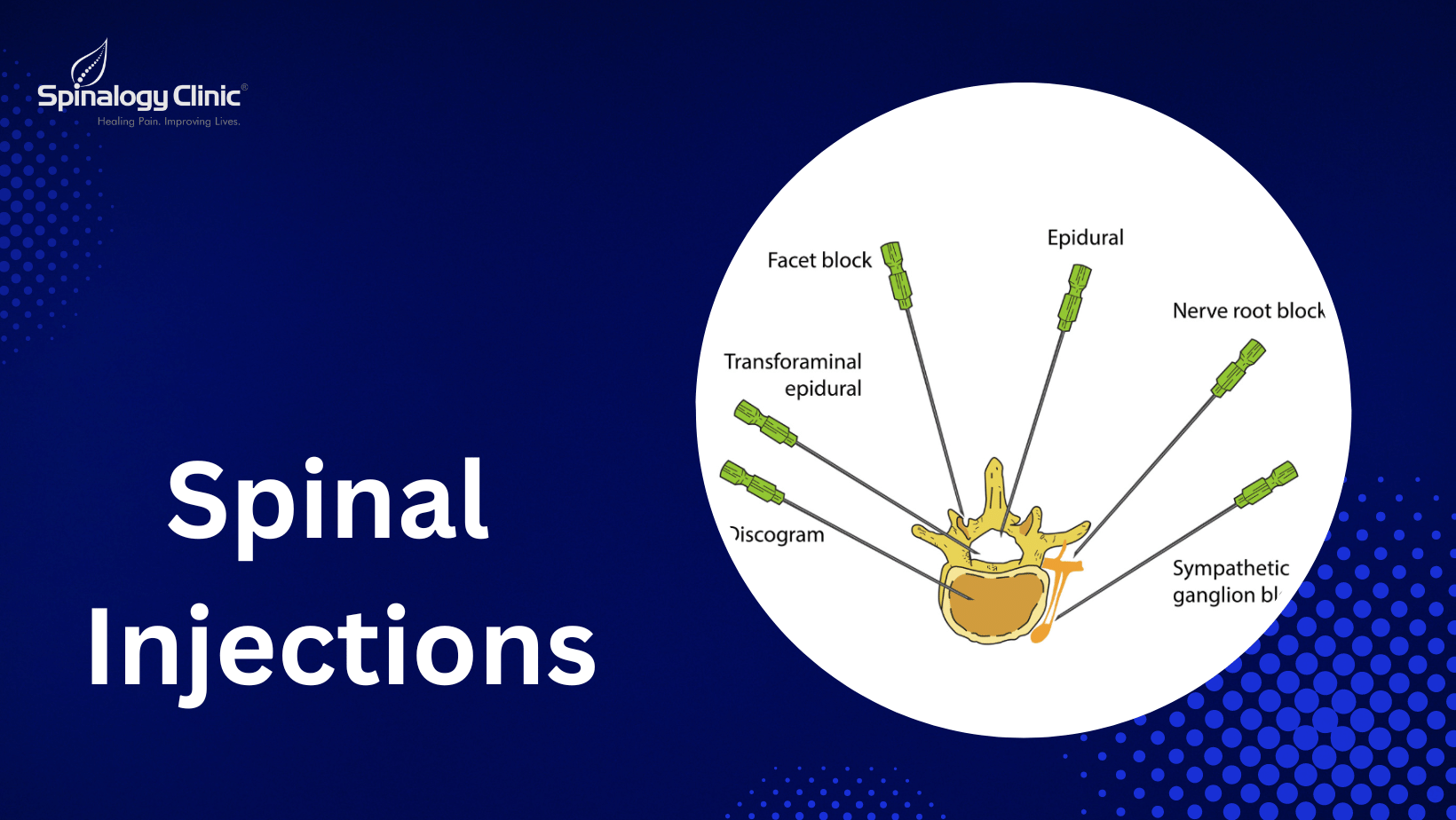 Spinal Injections